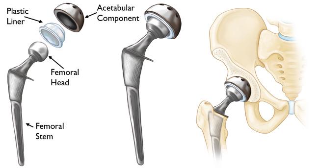 Image of the components of a total hip replacement and how it fits into the femur and pelvis