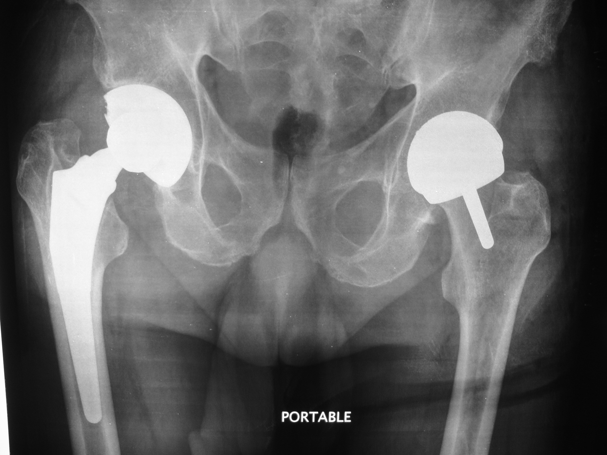 X-ray image of a total hip replacement and a hip resurfacing in the same patient